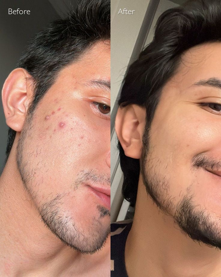 Rootivuh Zero Acne Soap Set