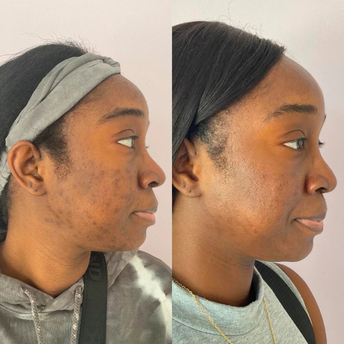 Rootivuh Zero Acne Soap Set