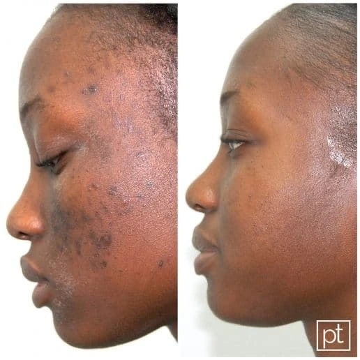 Rootivuh Zero Acne Soap Set