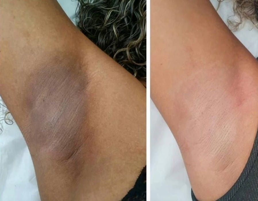 Rootivuh Zero Acne Soap Set