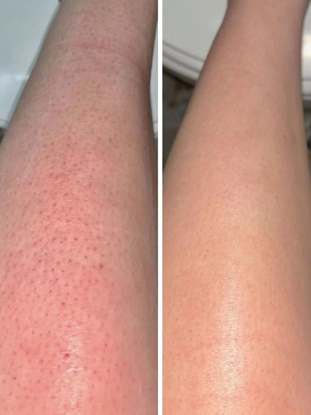 Rootivuh Zero Acne Soap Set