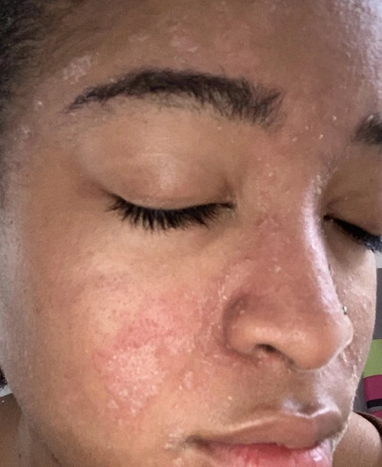 Rootivuh Zero Acne Soap Set