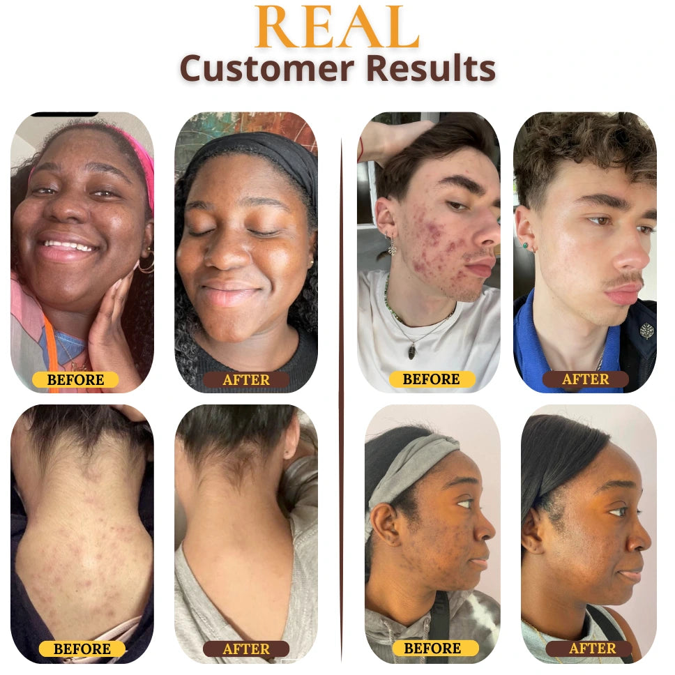 Rootivuh Zero Acne Soap Set